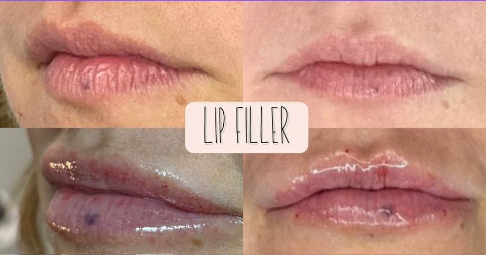 Juvéderm lip filler before and after views showing smoother, fuller lips