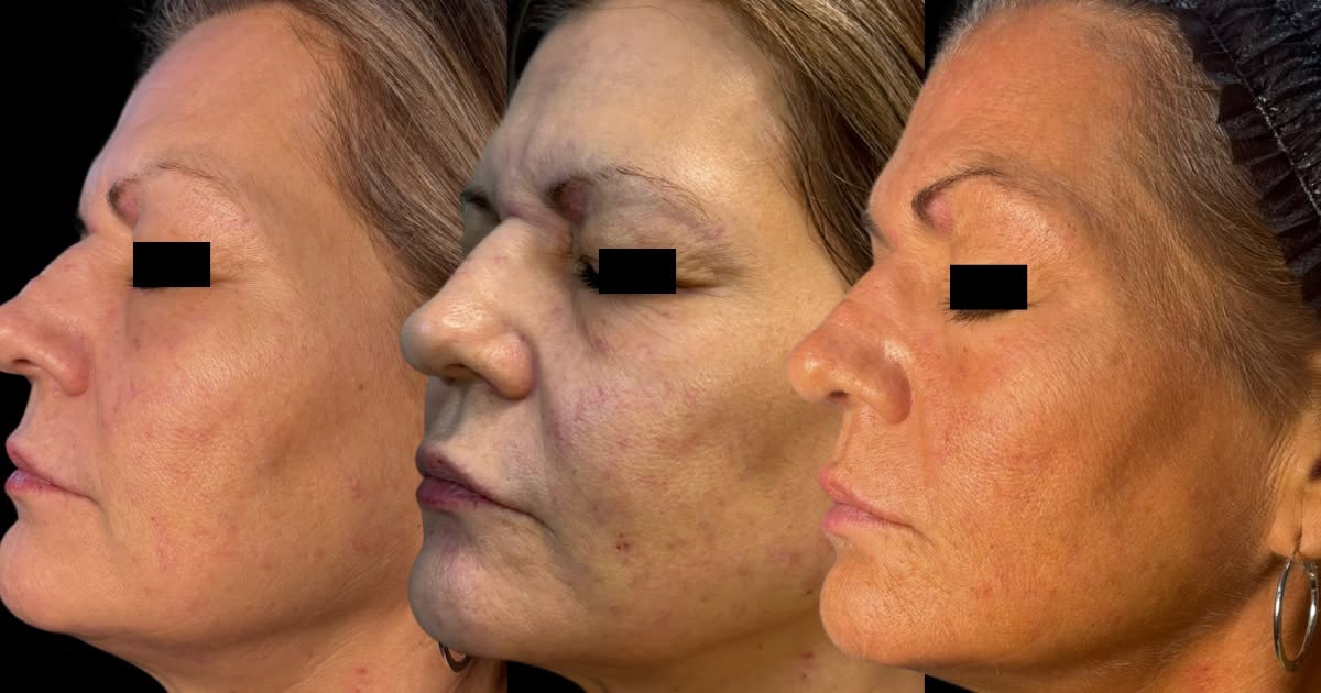 ClearLift laser treatment before-and-after progression of facial skin tone and texture