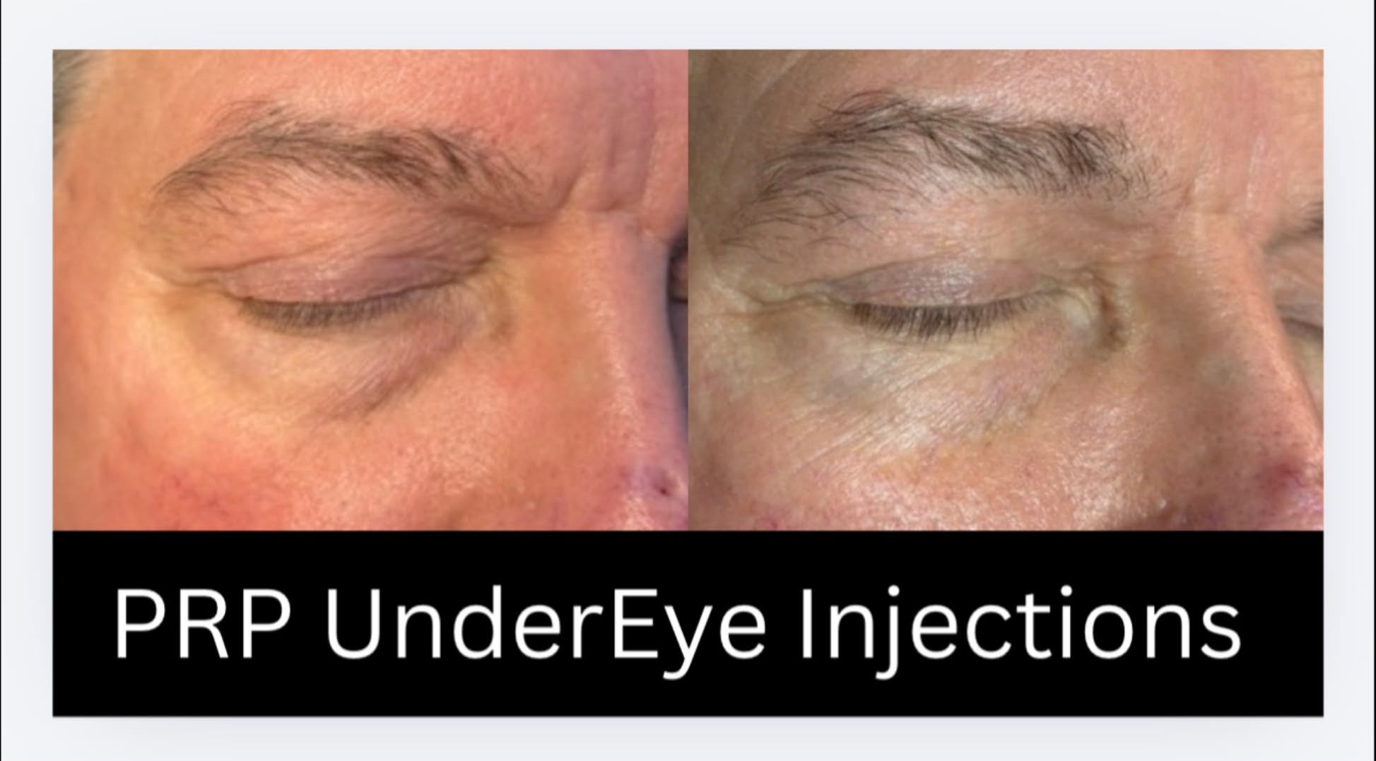 PRP under-eye injections before and after showing smoother under-eye skin