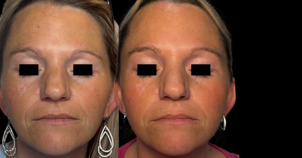 PRP microneedling facial before and after showing smoother, more radiant skin
