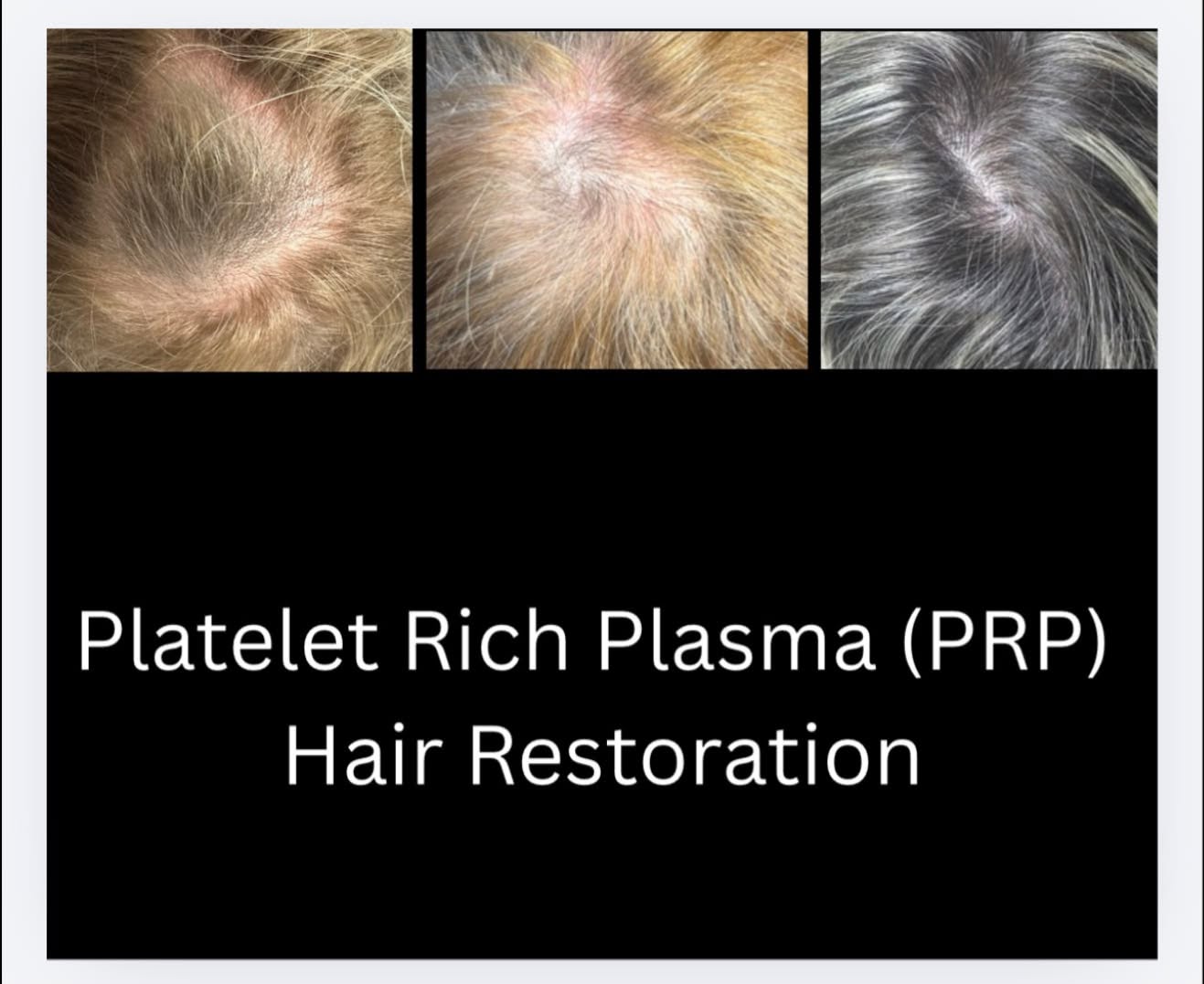 PRP hair restoration before-and-after series showing increased scalp coverage