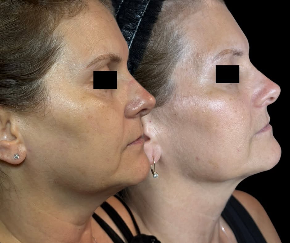 Microneedling facial before and after showing improved skin tone along the cheek and jawline