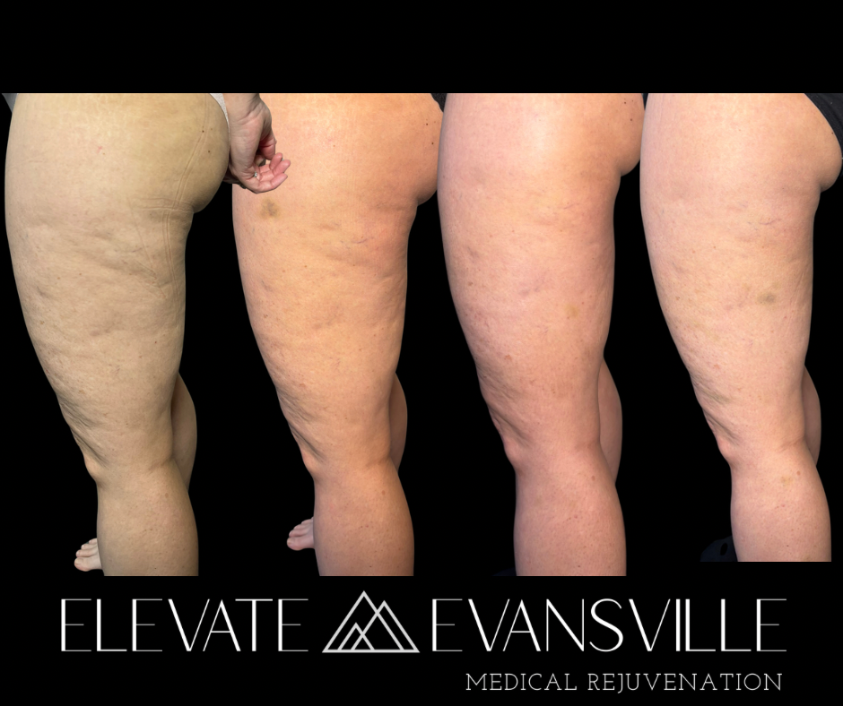 Fat cavitation thigh contouring before and after at Elevate Evansville