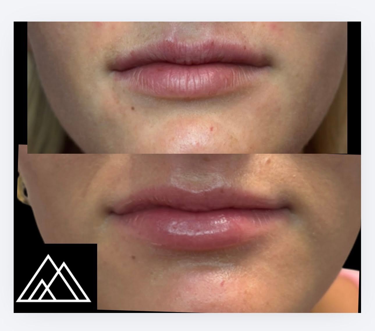 Juvéderm lip filler before and after showing added lip volume and definition