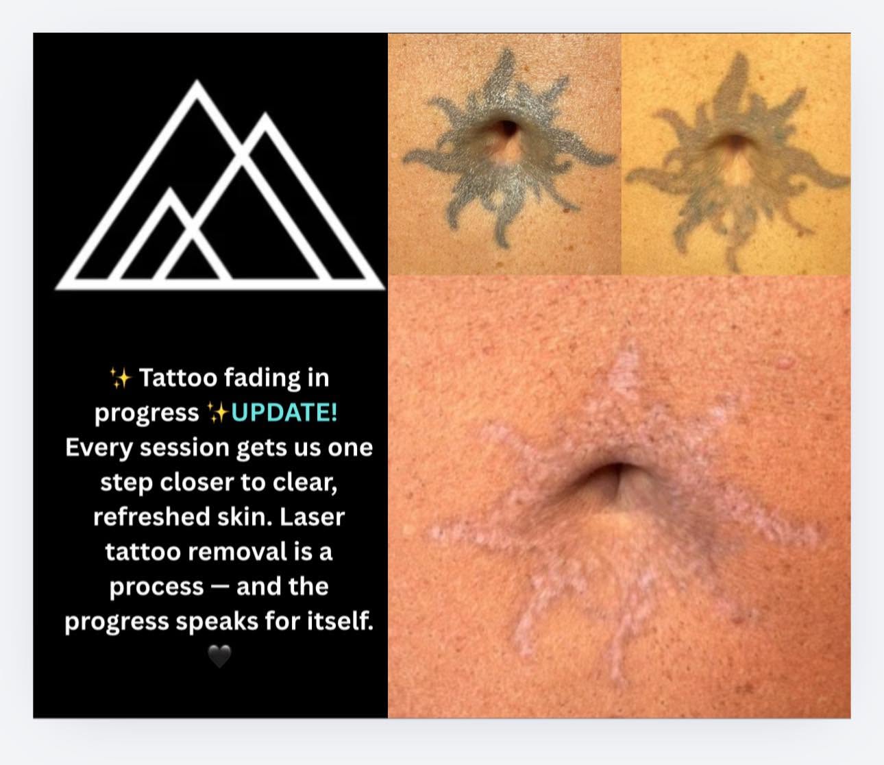 Laser tattoo removal progress showing a sun tattoo fading across multiple treatment sessions
