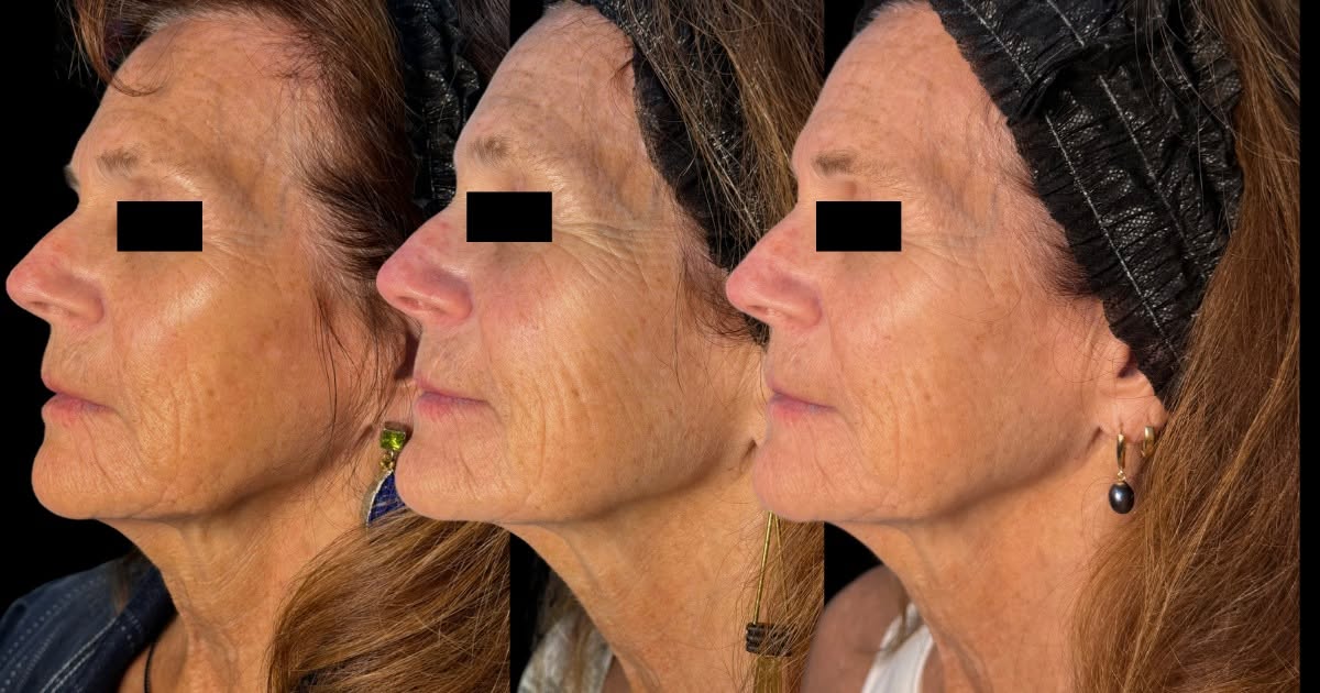 ClearLift laser rejuvenation before-and-after progression of facial fine lines and skin texture