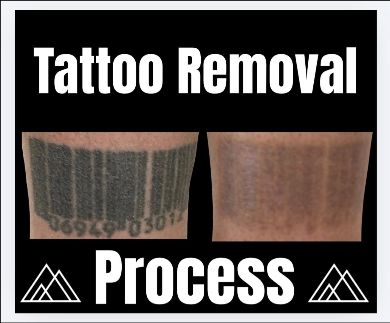 Laser tattoo removal before and after showing significant fading of a dark barcode tattoo