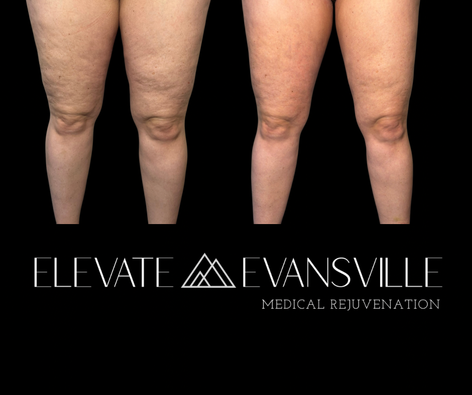Fat cavitation thigh and knee before and after at Elevate Evansville