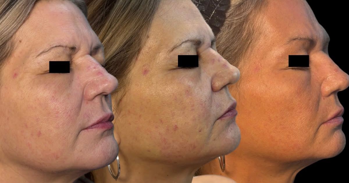 Microneedling facial before-and-after progression showing improved skin texture and reduced redness