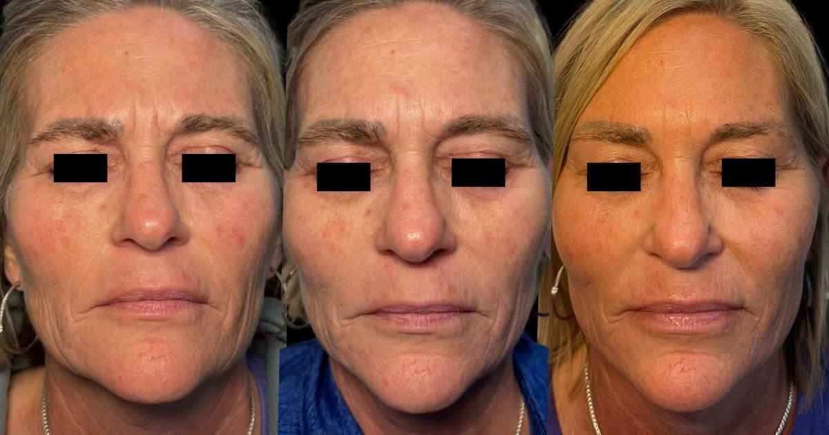 PRP facial before-and-after series showing improved skin tone and texture