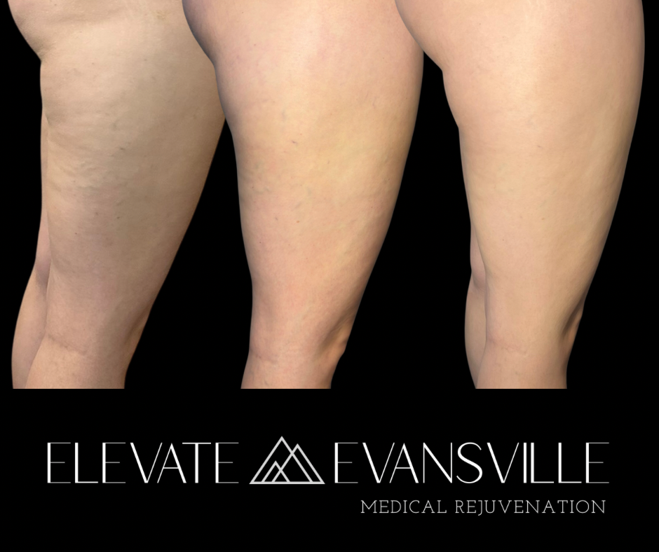 Sclerotherapy treatment result showing gradual fading of spider veins on the legs